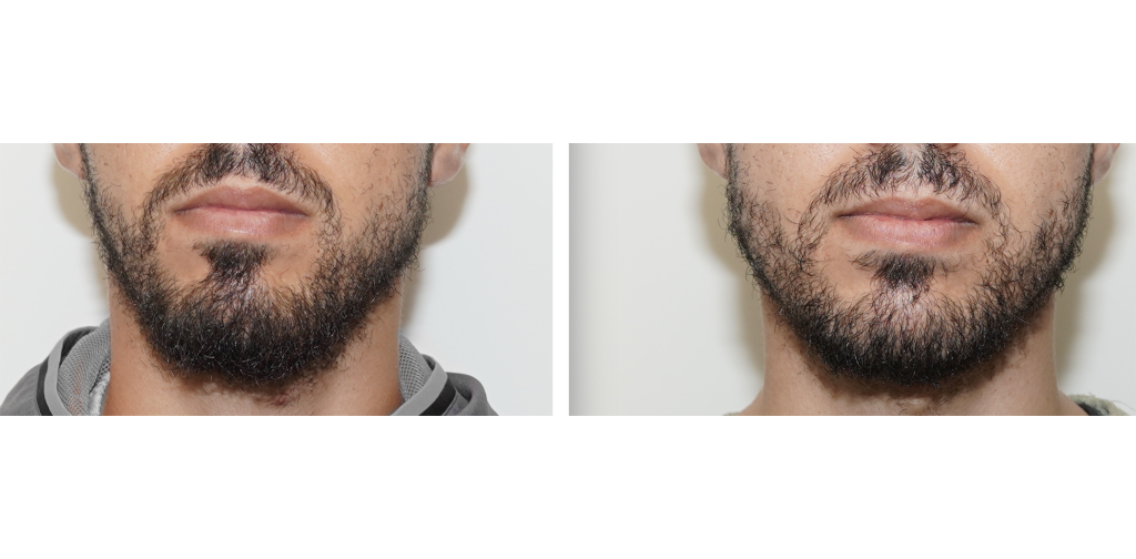 Tiers inférieur du visage avant/après